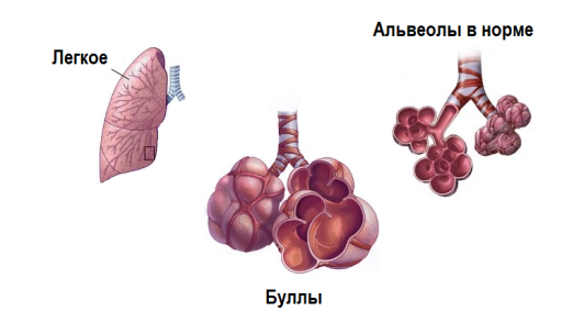 Эмфизема буллезная форма. Эмфизема легких Буллы в легких.